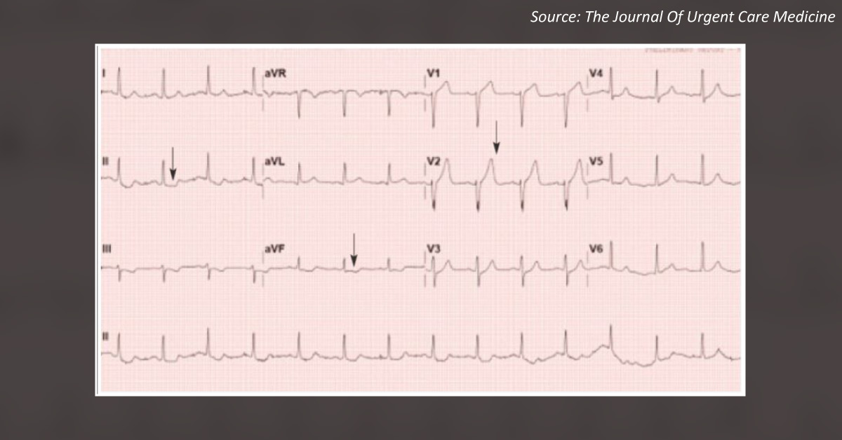 Sudden Onset of Chest Pain: What Could be the Cause?