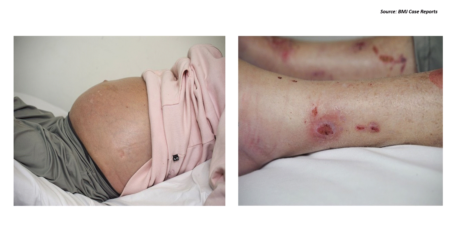 A Rare Case of Malnourishment and Complications