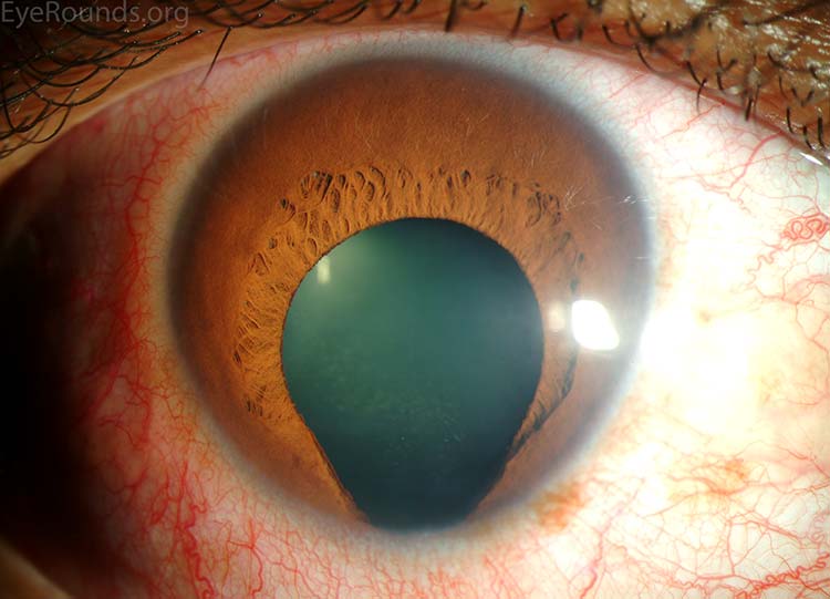 What This Anterior Segment Reveals?