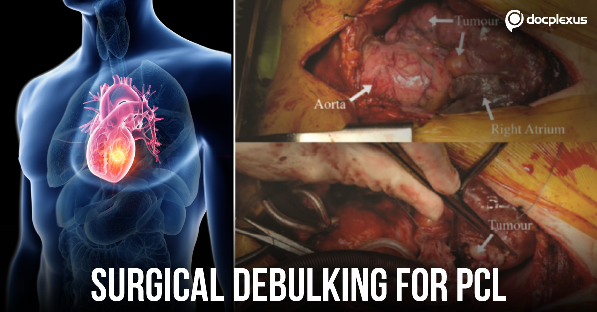 Primary Cardiac Lymphoma Managed By Early Surgical Debulking