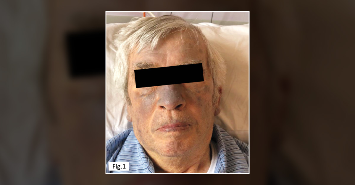 A Geriatric Patient With Unusual Skin Discoloration