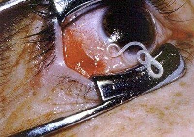Name The Ocular Parasite
