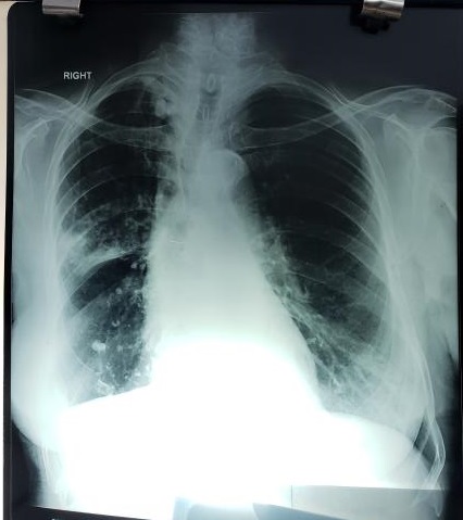 Why Tracheo-Bronchial Shadow Is Curved?