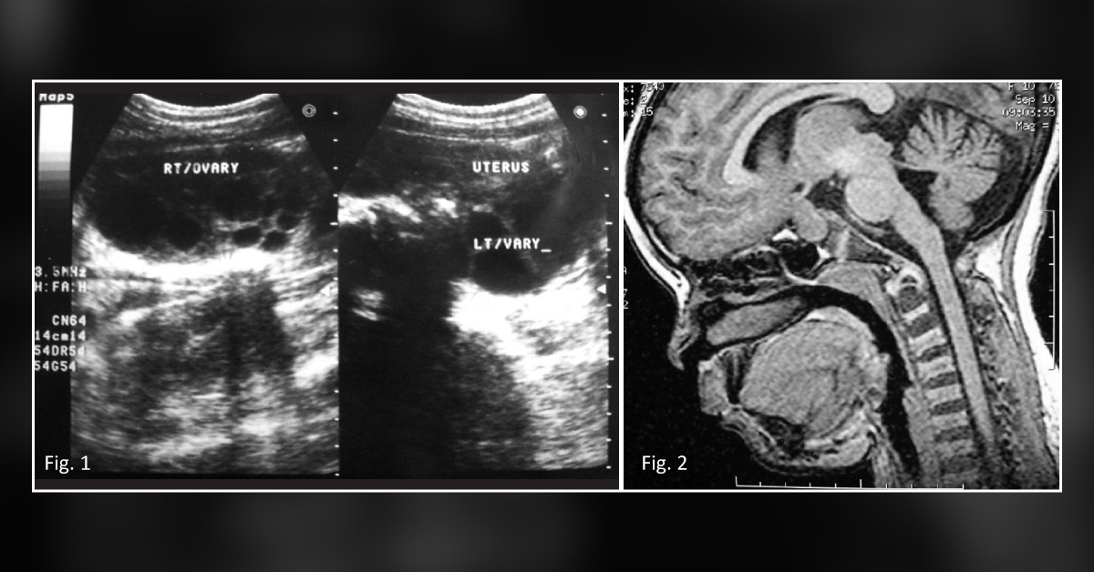 An Unusual Case of Breast Enlargement at in a 10-year-old