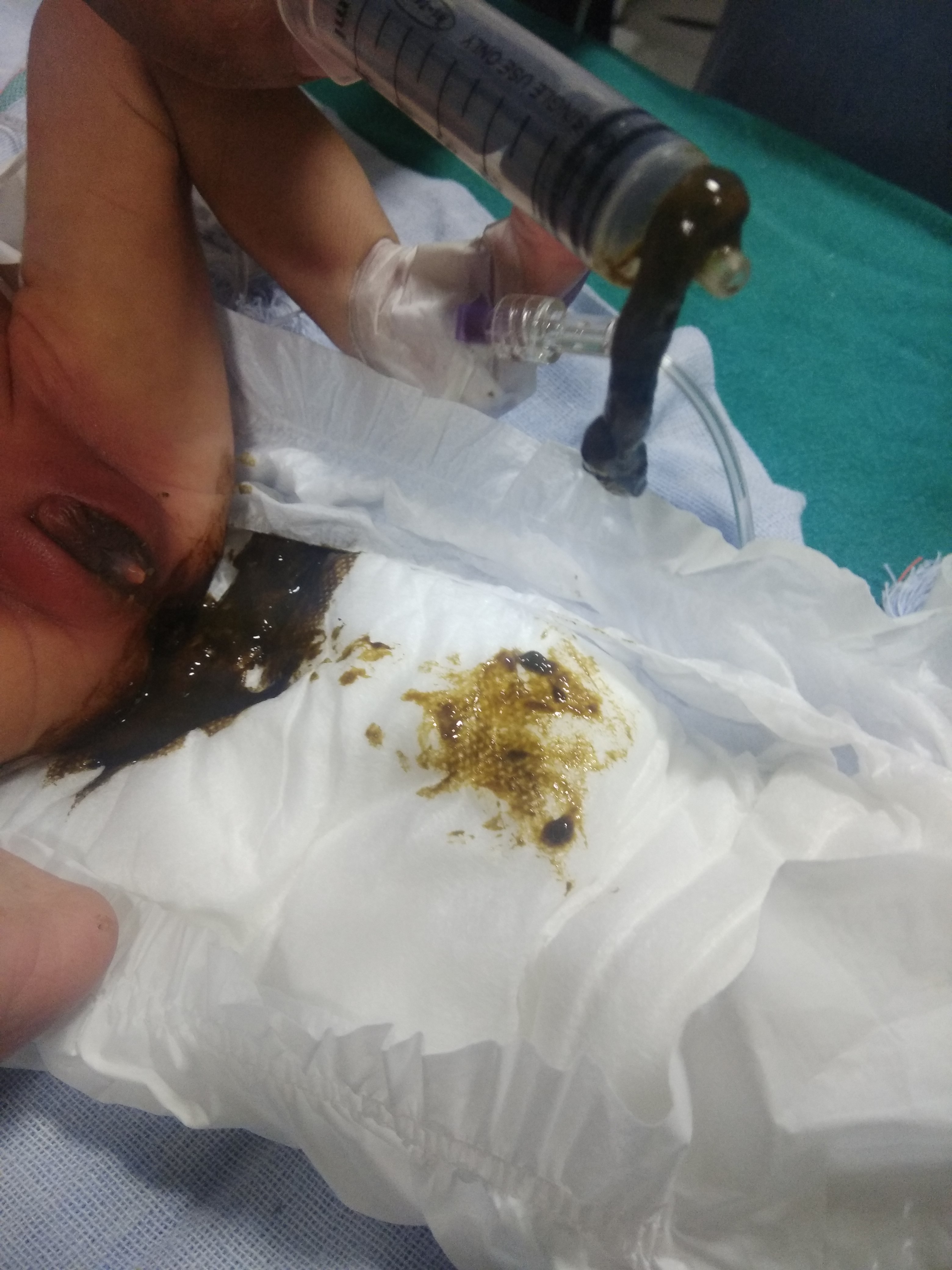 Worm Like Tissue In Stool