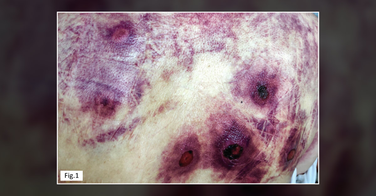 A Case of Chronic Purple Lesions on the Skin