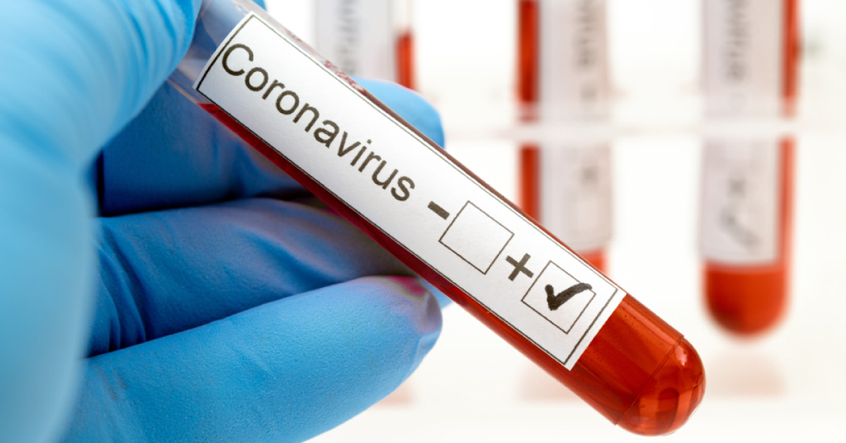 Diagnostic Test For COVID-19