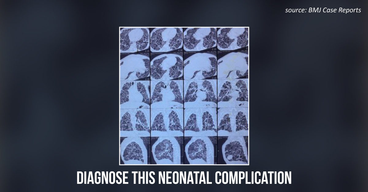 Rare Neonatal Disease Masquerading as a Pulmonary Complication: Can You Diagnose the Condition?