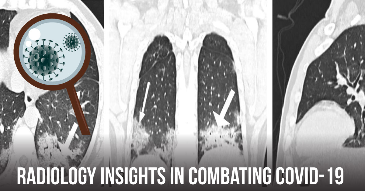 Trial On Radiological Investigation Of COVID-19 Clinical Features