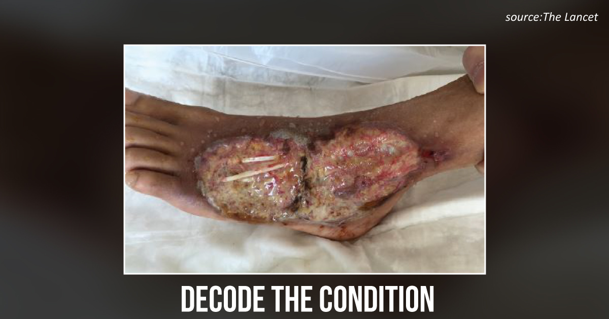 Ace the Case of an Ulcerative Lesion in a Man