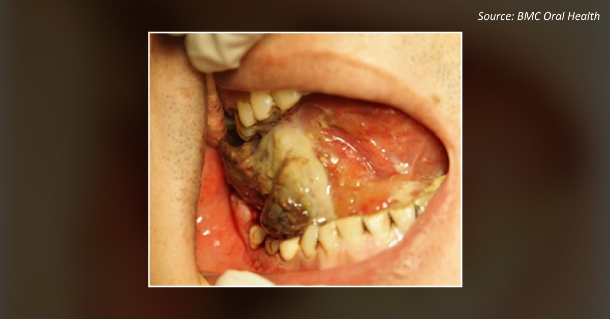 Diagnose This Case of Misdiagnosed Fibroadenoma