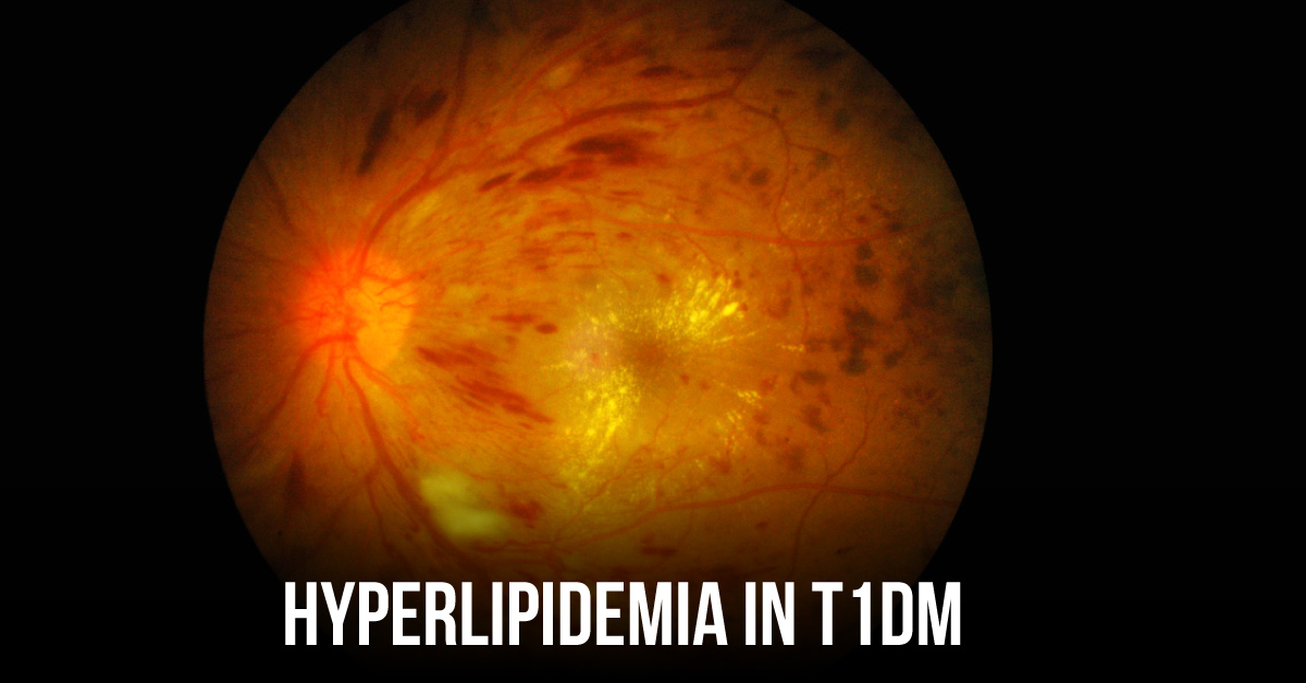 Hyperlipidemia in T1DM