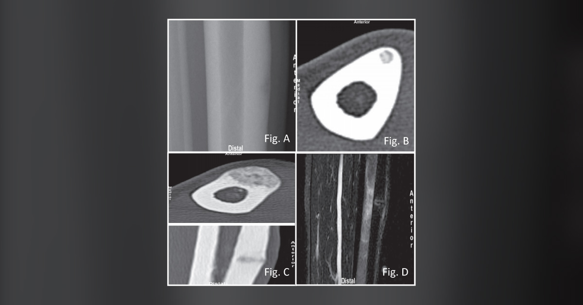 Identify the Reason Behind Swelling in the Tibial Region in This Basketball Player