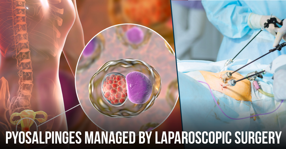 A Case of Pyosalpinges Managed by Laparoscopic Surgery