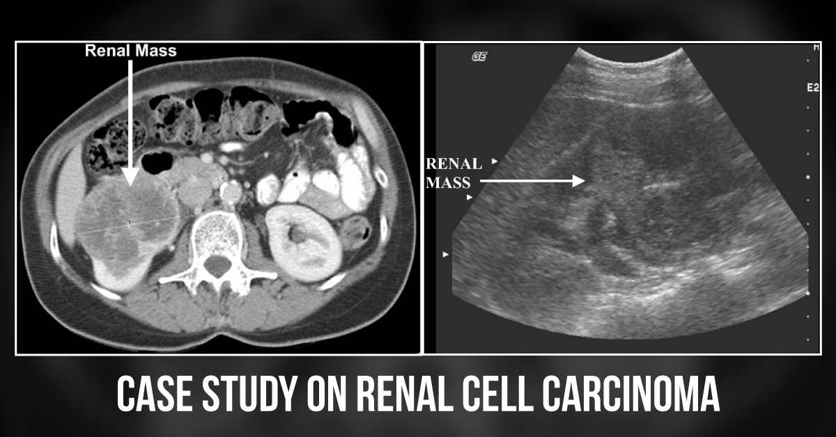 Case Study on Atypical Presentation of Renal Cell Carcinoma