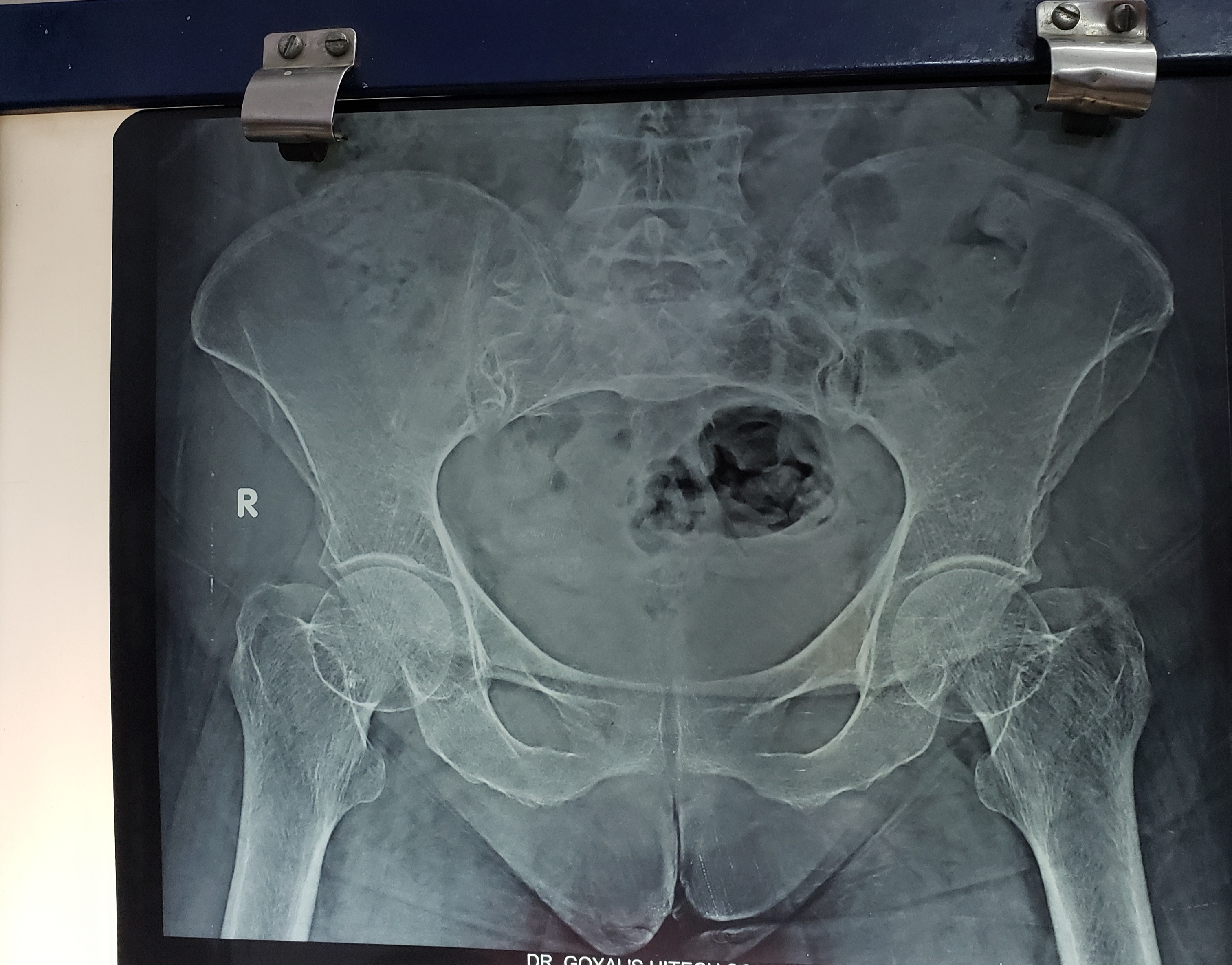 Pelvis X-ray Of An Old Lady