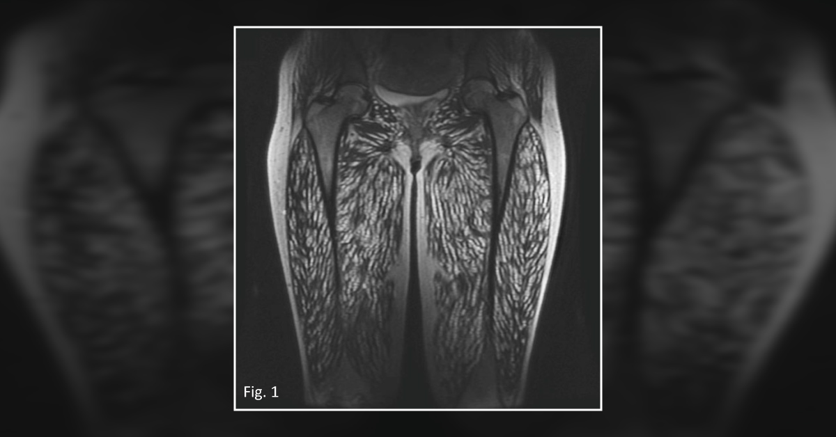 Diagnose the Cause of Hypertrophic Appearance of the Thigh