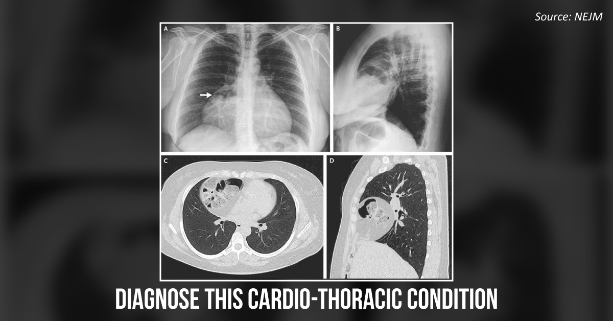 A Middle-aged Woman with Dyspnea and Arrhythmia