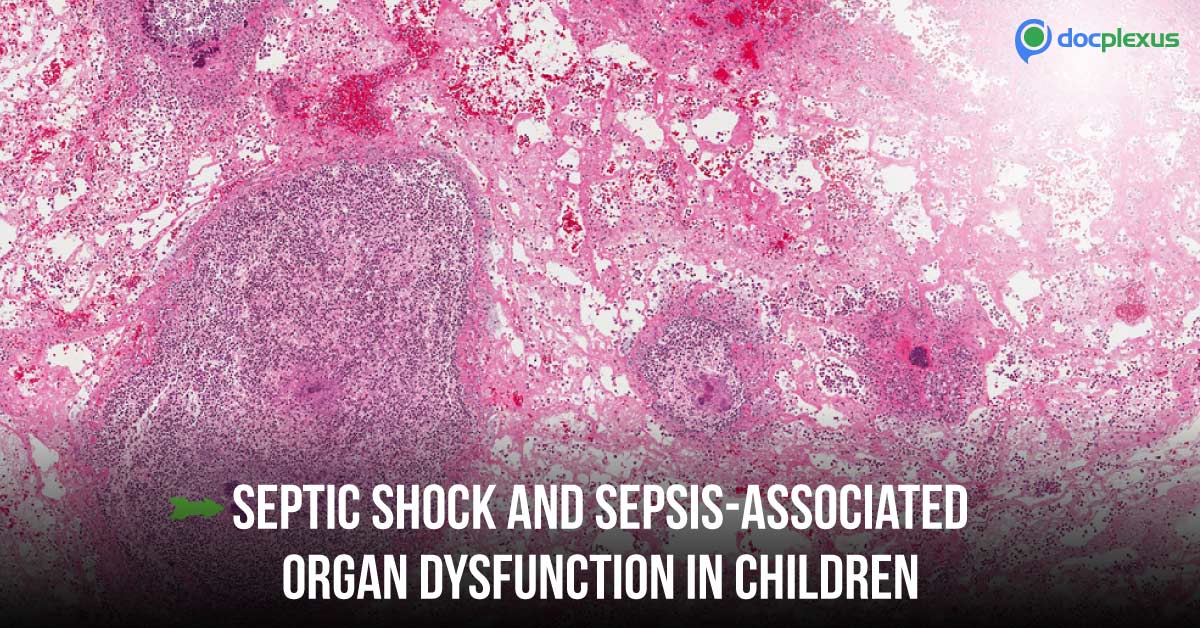 Septic shock In Children: Updated Guidelines