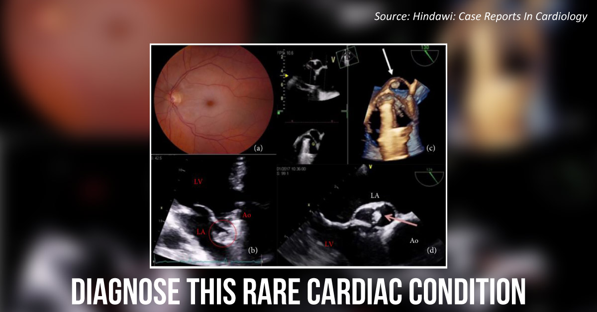 Case of Vision Loss Due to a Heart Condition