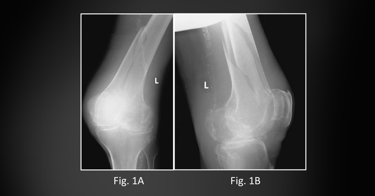 Knee Pain Following A Road Traffic Accident