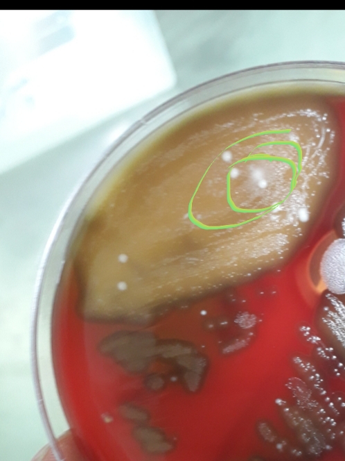 Shortness Of Breath In Old Age Diabetic Case
