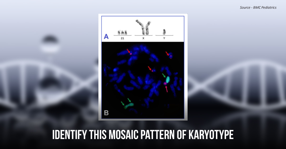 Diagnose This Unique Phenotype Accompanied with Down Syndrome