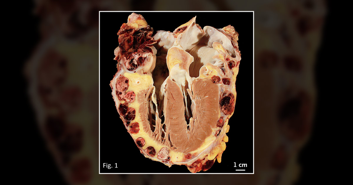 A Case Of A Geriatric Patient With A Fatal Disease Outcome