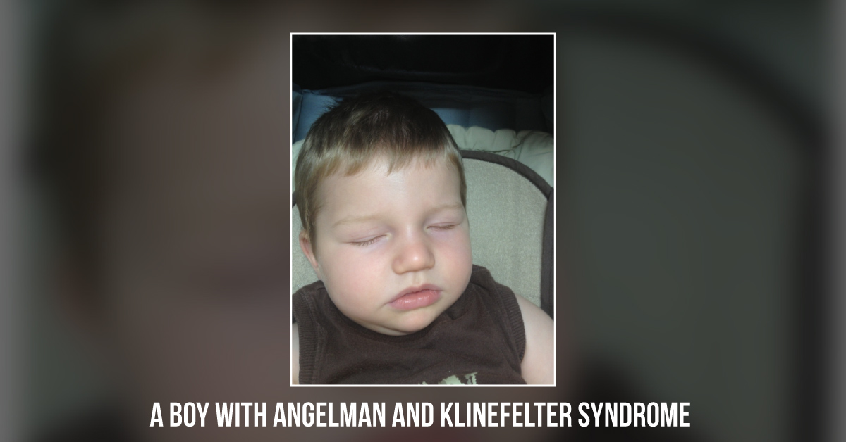 An Infant With Dysmorphic Features And Hypotonia