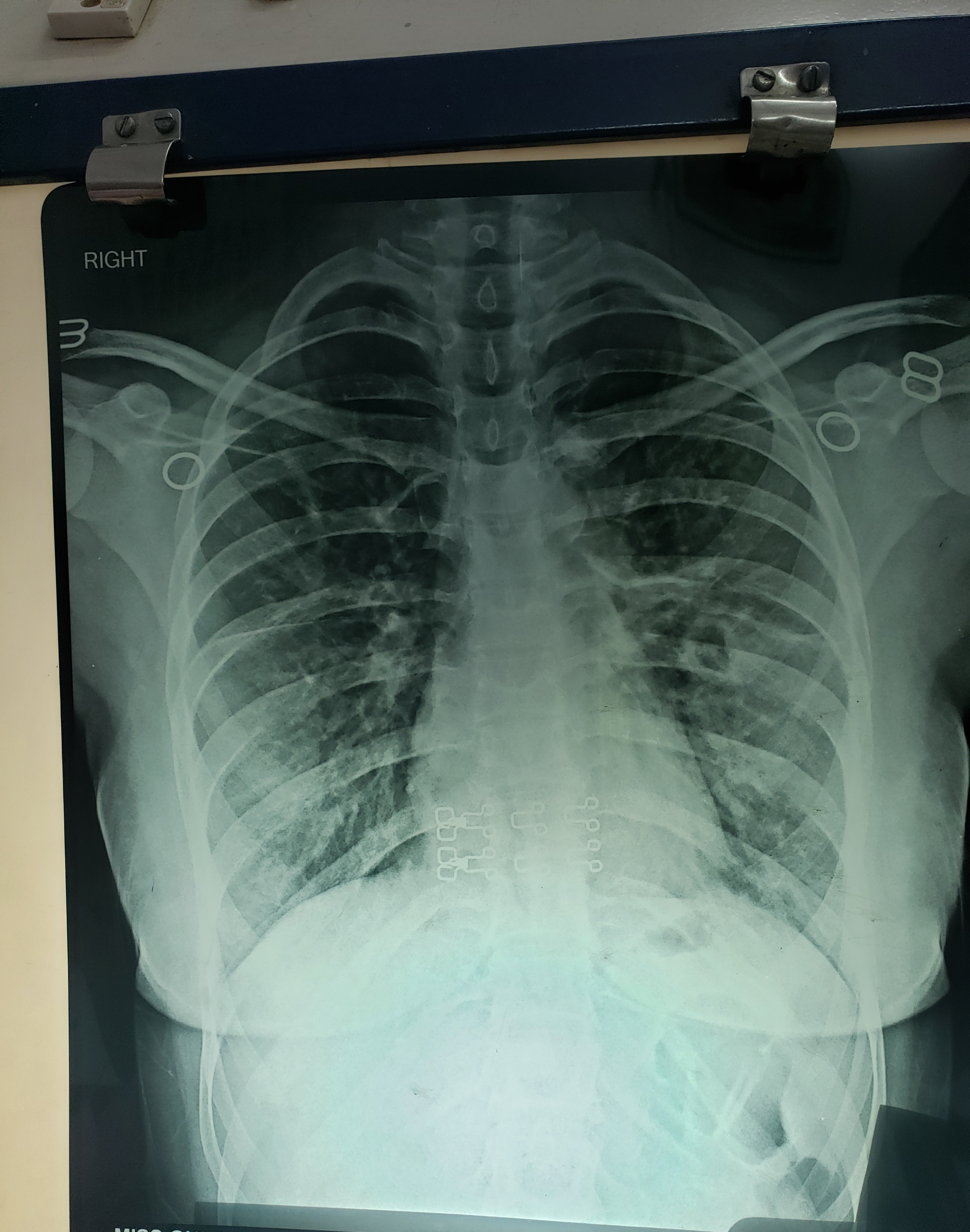 What Is The Cause Of Pain On Lt Lateral Side Of Chest In 19 Years Girl?
