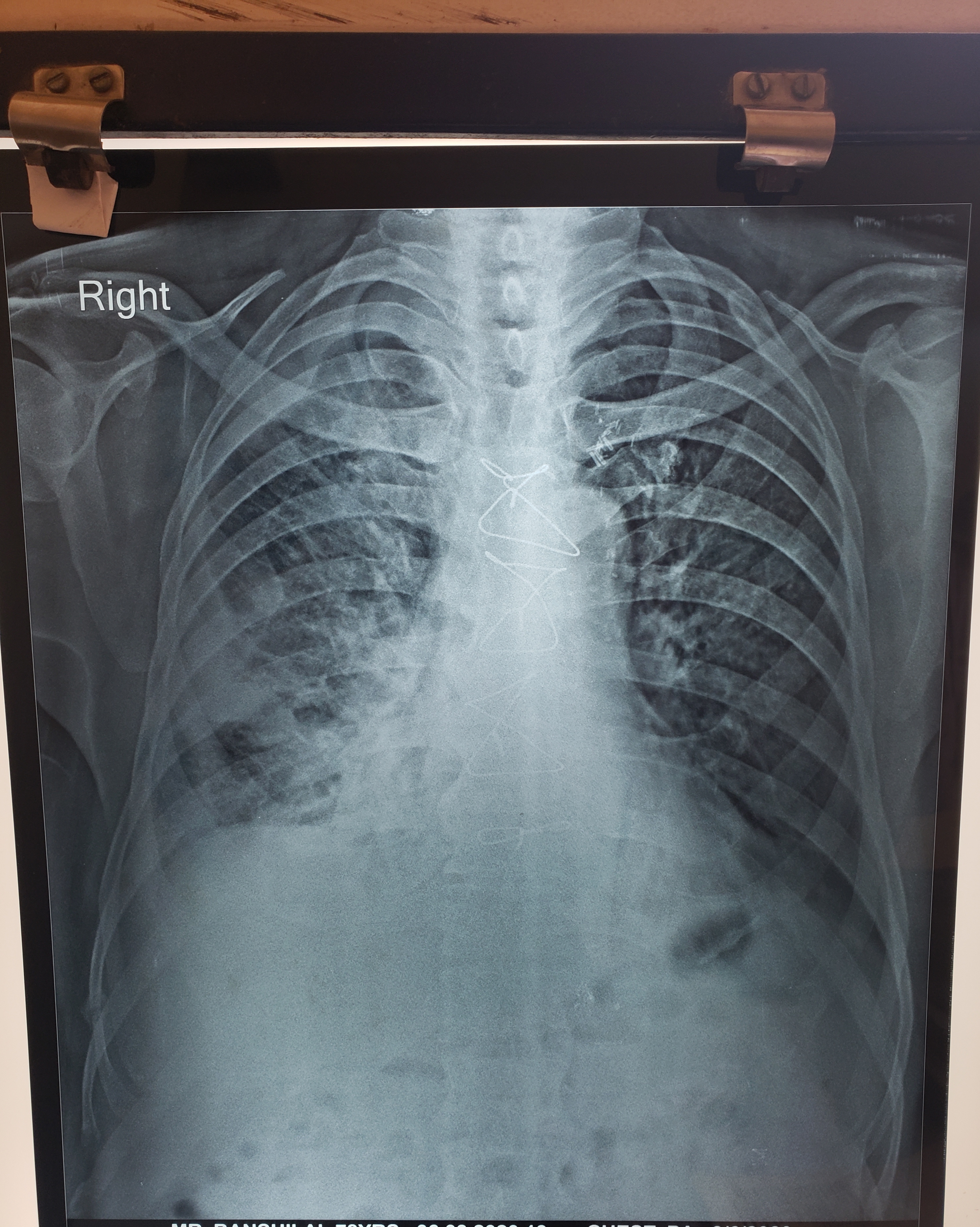Predict The Problem In This X-ray Chest PA View?