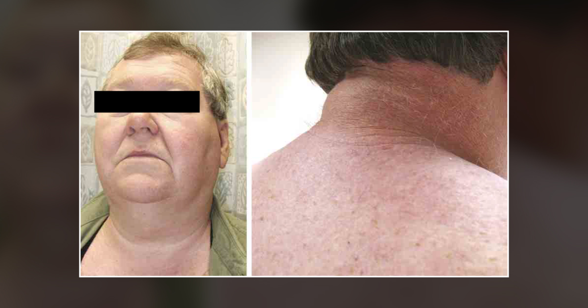 What Would You Suggest for This Diabetic Patient with Persistent Pain, Stiffness, and Headache?