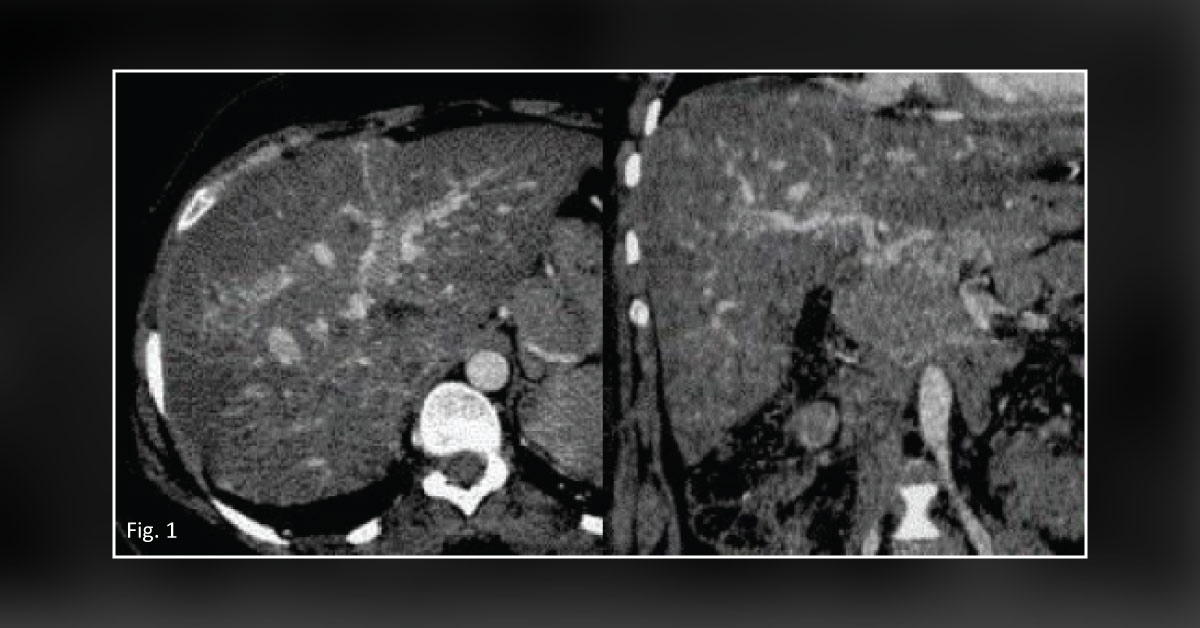 An Uncommon Gynecological Complication Associated With A Genetic Condition