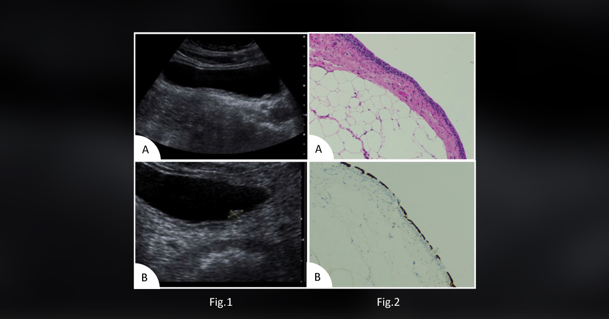 A Man with a Bladder Lesion
