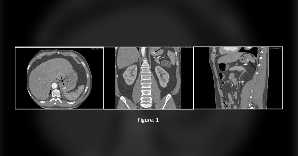 Can a Potassium Tablet Mimic Active Gastric Bleeding?