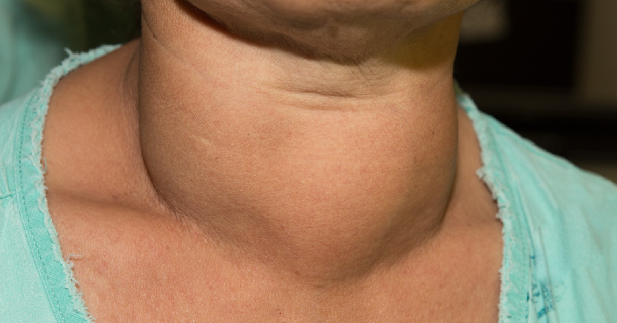 Unusual Lateral Neck Swelling In A Female