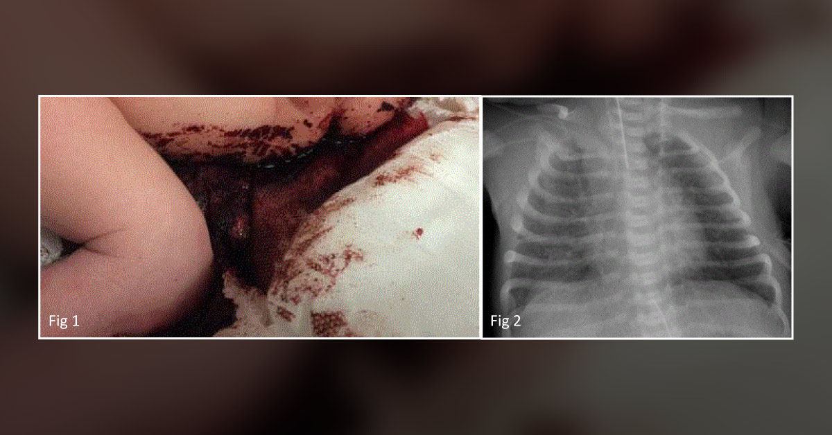 An Infant with Hemorrhagic Amniotic Fluid at Birth