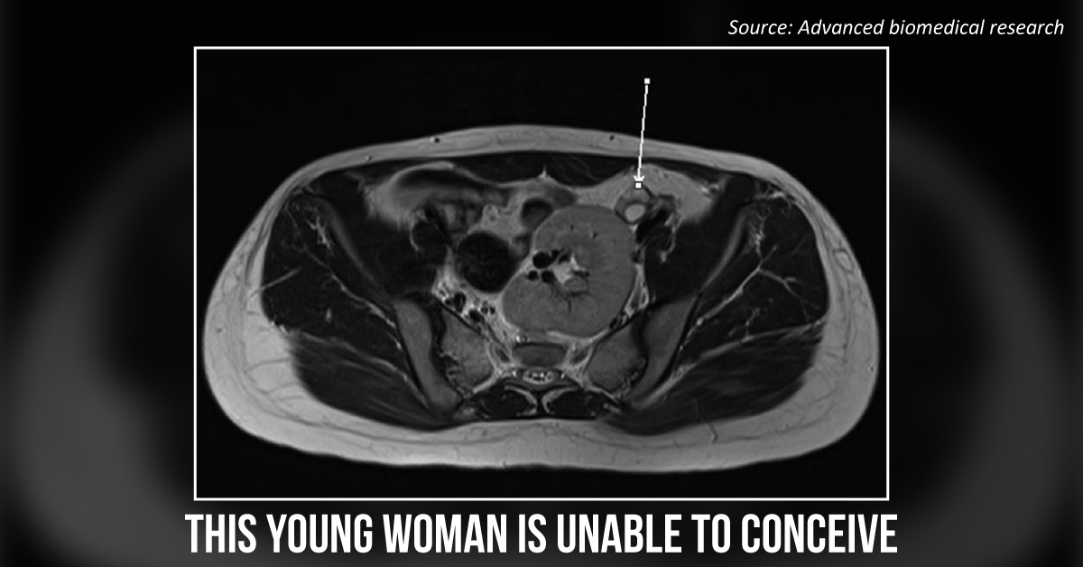 Case of a Young Lady Who is Unable to Conceive Due to a Rare Syndrome