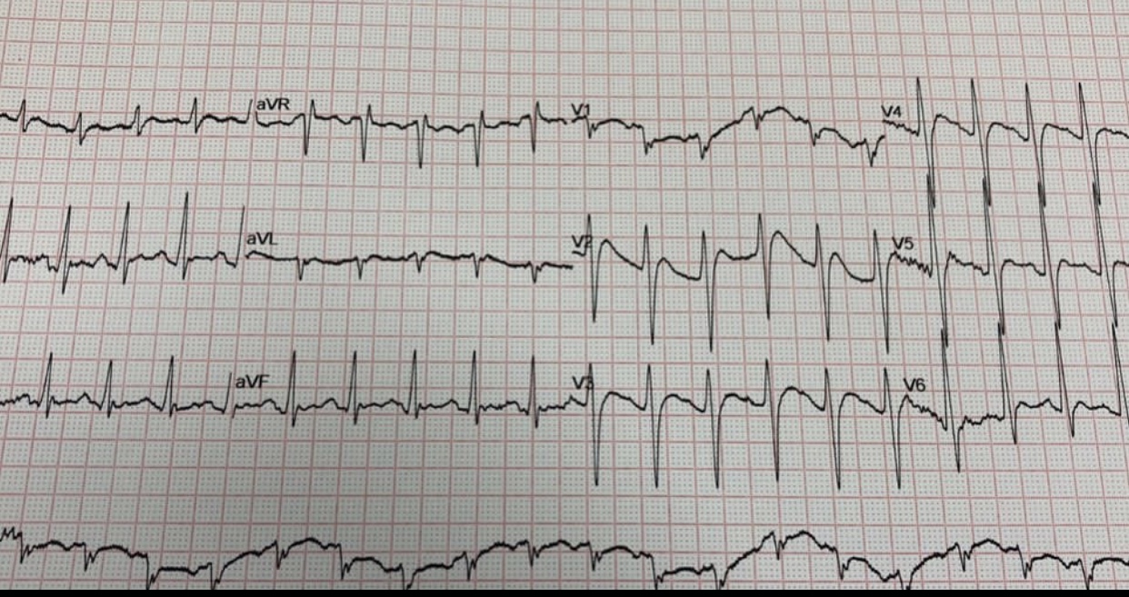 Can You Diagnose This ECG?
