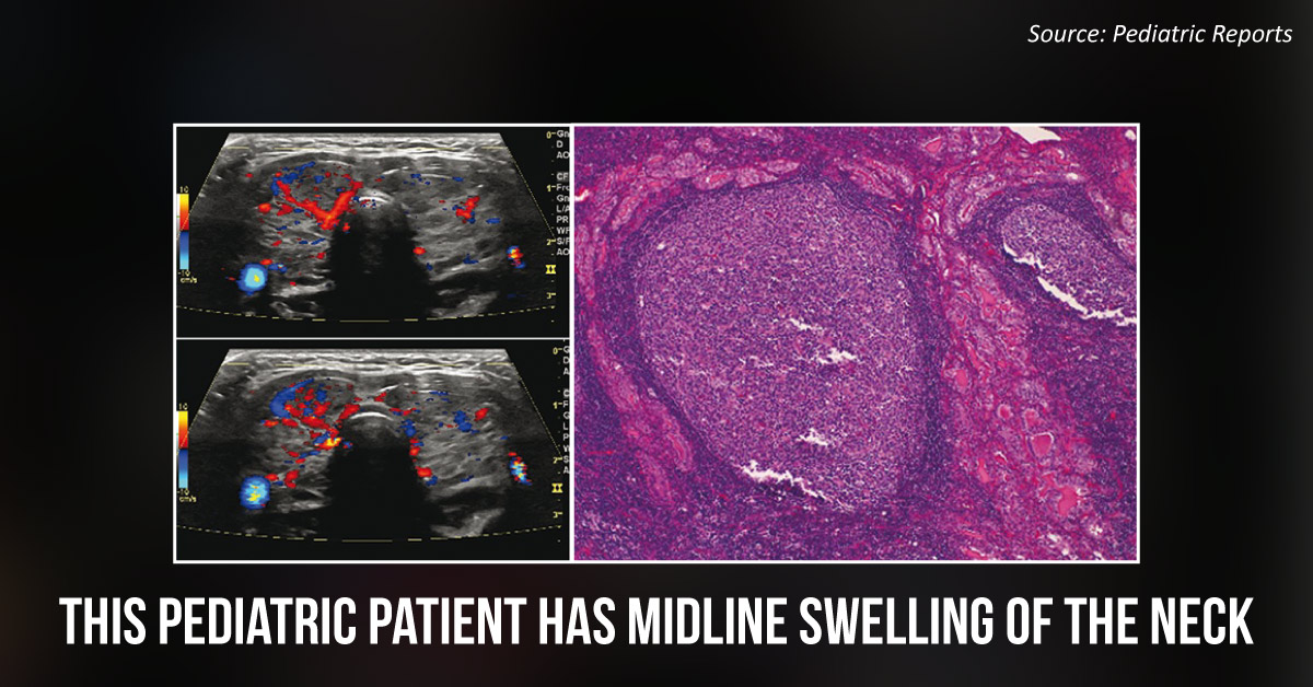 A Teenager with Complaints of Fatigue, Malaise and Enlarged Thyroid Gland