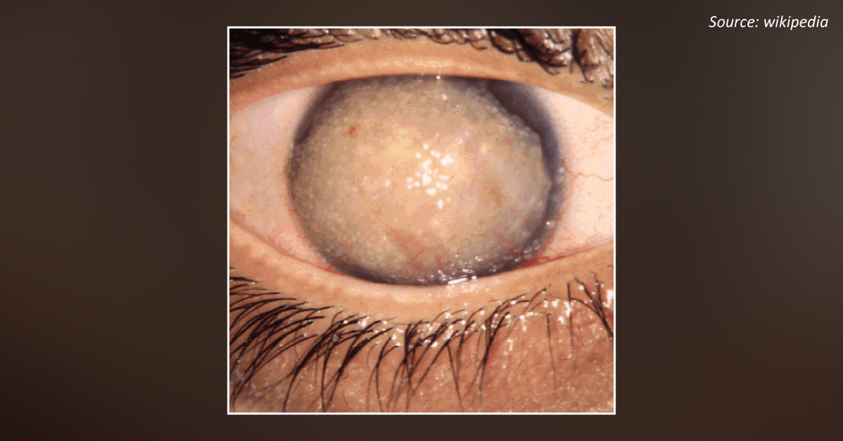 Causes Of Prominent Corneal Nerves
