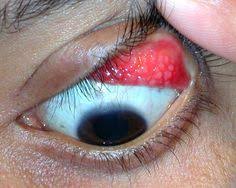 Diagnose The Eye Condition