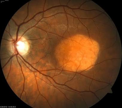 Diagnose This Retinal Abnormality