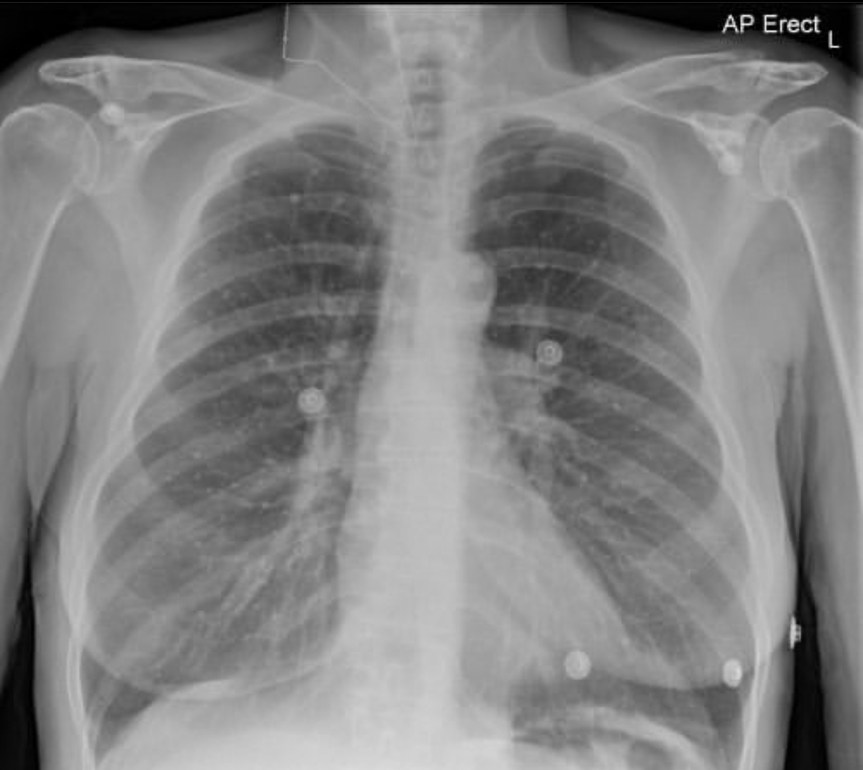 Manage This Case Of Pneumonia