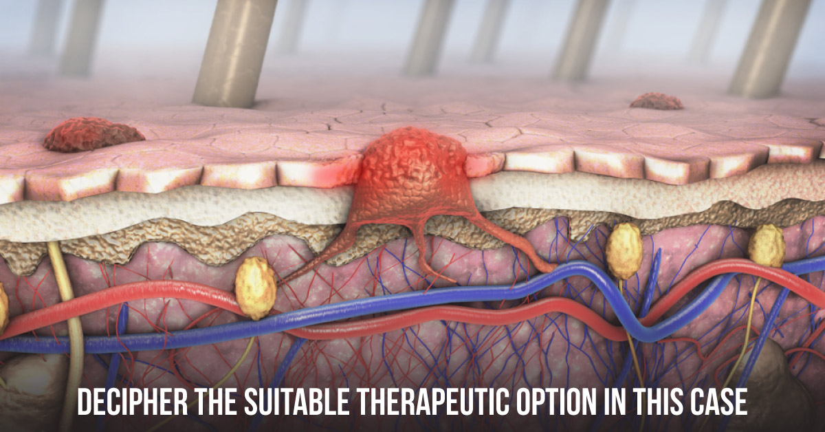 Recommend The Most Preferred Treatment In This Case