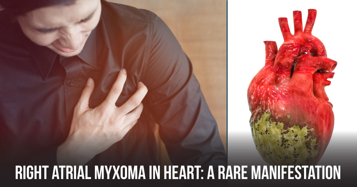 A Rare Manifestation Of Giant Right Atrial Myxoma