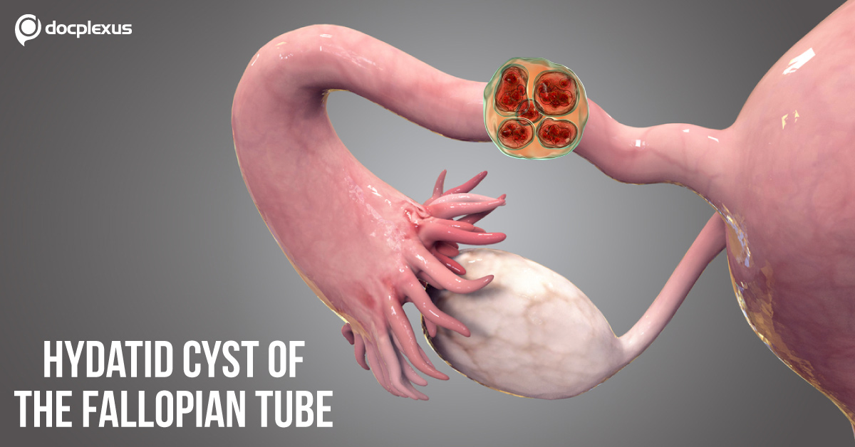 A Rare Presentation of a Hydatid Cyst of the Fallopian Tube