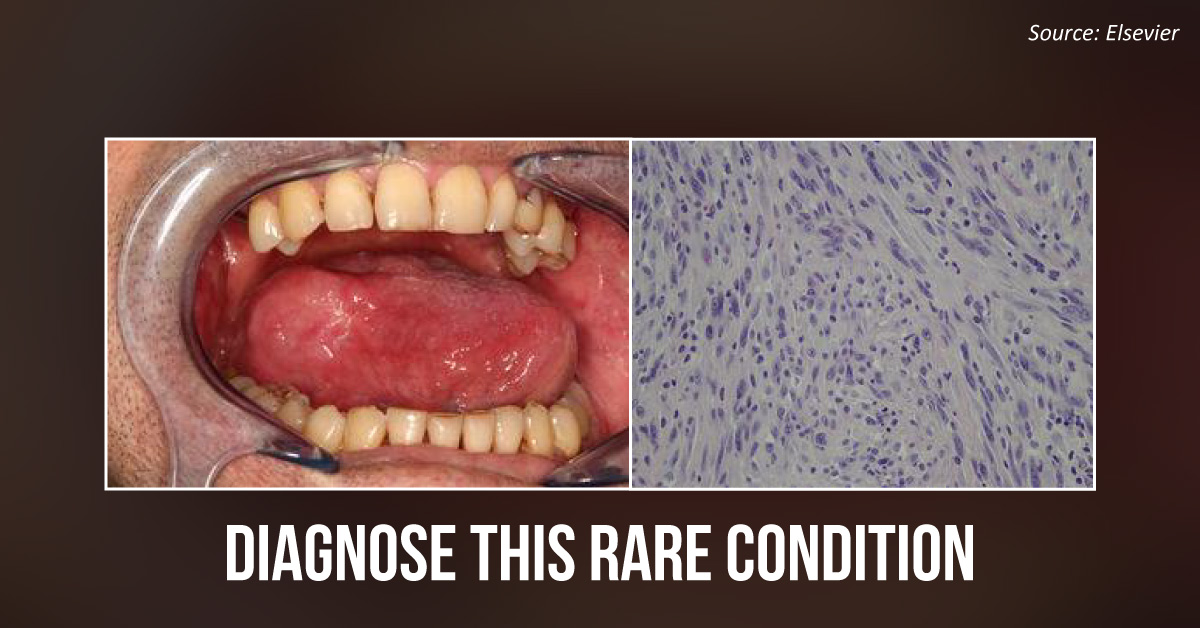 Negative Biopsy Report Turns Fatal for a Patient
