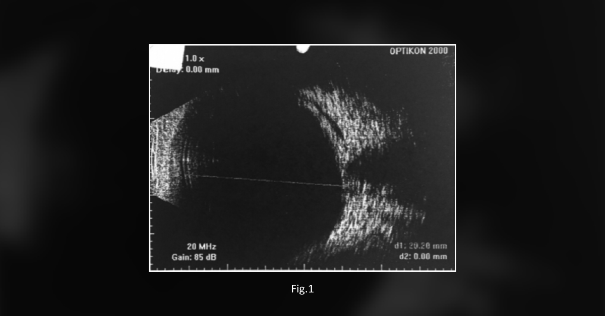 Visual Loss Post Spine Surgery: A Case Report