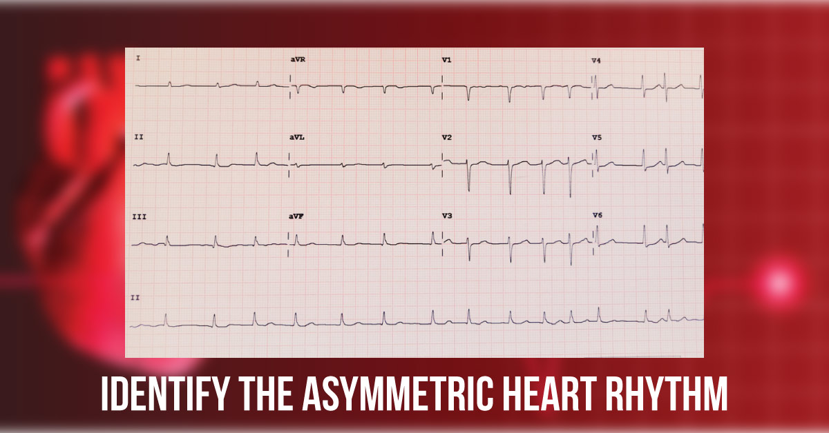 Suggest The Probable Heart Rhythm Disorder